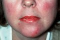 Ratgeber: Alarmstufe Rot Hautkrankheit: Wie man mit Rosacea möglichst stressfrei